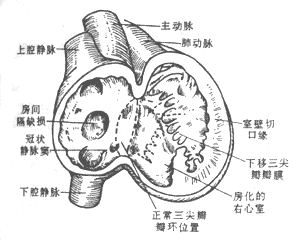 三尖瓣發育異常
