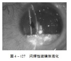 閃輝性玻璃體液化